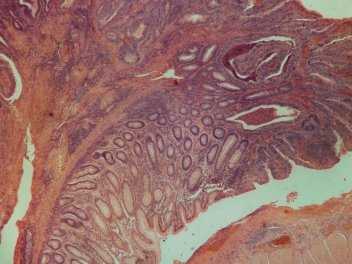 Описание: слайд 8 карцинома, микро