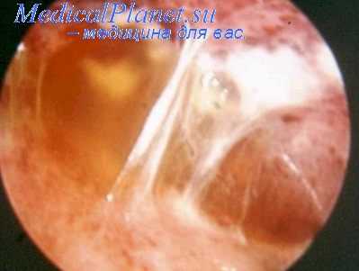 операция на диафрагмальном нерве