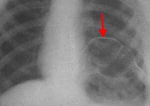 релаксация диафрагмы рентген