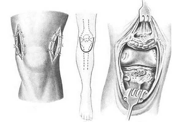 артротомия коленного сустава