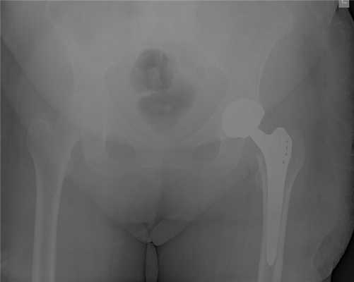 эндопротезирование при переломе шейки бедра