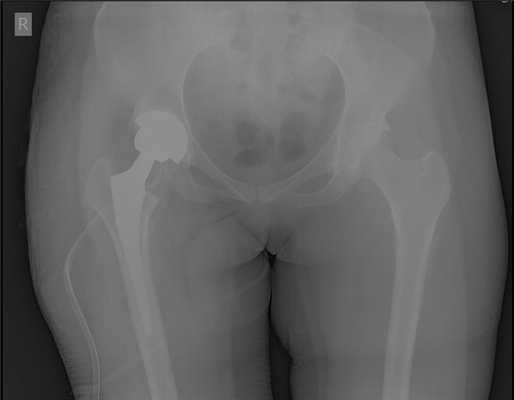 эндопротезирование при дисплазии тазобедренного сустава