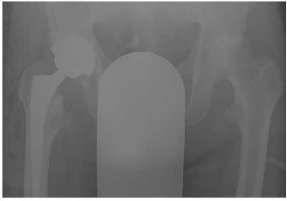 эндопротезирование тазобедренного сустава