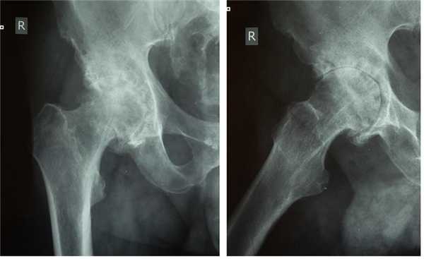 асептический некроз головки бедра
