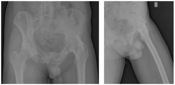 анкилоз тазобедренного сустава