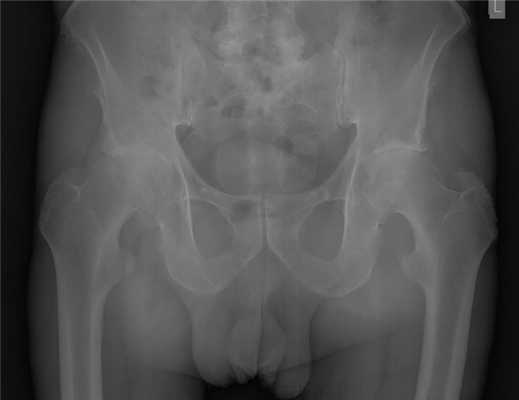 коксартроз