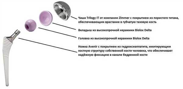керамический эндопротез тазобедренного сустава