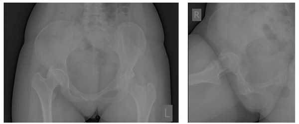 коксартроз при дисплазии тазобедренного сустава