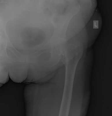 перелом шейки бедра