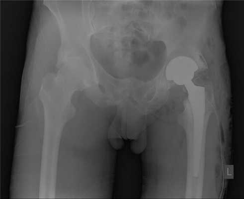 эндопротезирование при анкилозе тазобедренного сустава