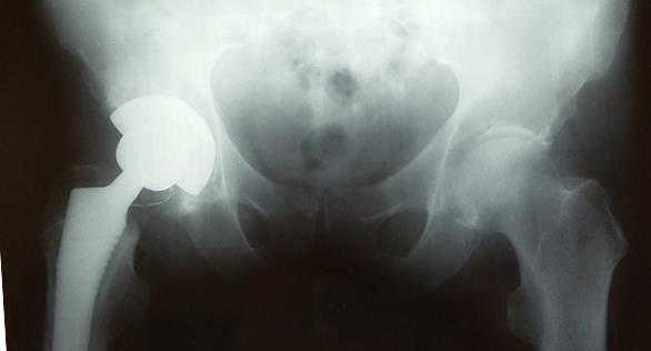 эндопротезирование керамика