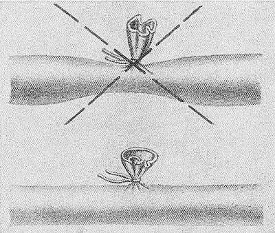 Рис. 2. Схематическое изображение боковой перевязки сосуда: внизу — правильная, вверху — неправильная.