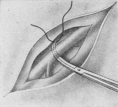 Рис. 1. Схематическое изображение перевязки сосуда на протяжении: под выделенный сосуд подводится двойная лигатура.
