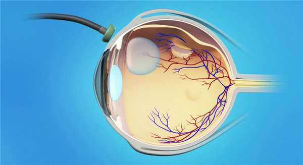 Пневморетинопексия - что представляет собой операция