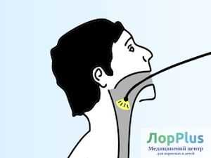 Ларингоскопия