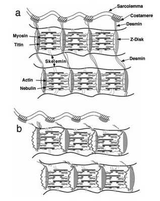 Схематическая диаграмма гипотетического механизма разрушения Z-диска. Миозиновые филаменты, которые смещены из-за неравенства силы поперек саркомера, можно тянуть к одной стороне саркомера (a) - нормальное расположение миофибрилл (b) смещение миофибрилл. Широкие Z-диски как свидетельство Z-дискового «размытия» в электронном микроскопе (Frieden J., Lieber R.L.2001)