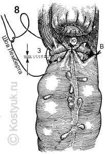 тостокишечно-ректальный анастомоз хирургическим степлером 8