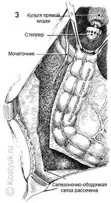 тостокишечно-ректальный анастомоз хирургическим степлером 3