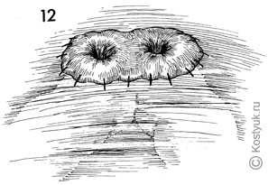 тостокишечно-ректальный анастомоз хирургическим степлером 12