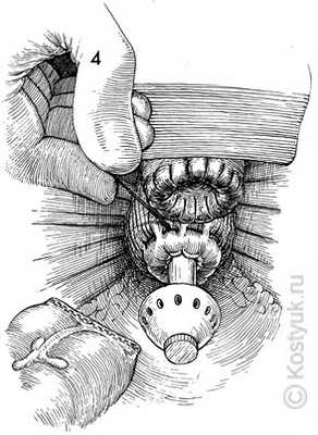 тостокишечно-ректальный анастомоз хирургическим степлером 4