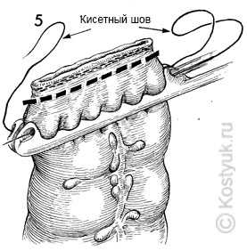 тостокишечно-ректальный анастомоз хирургическим степлером 5