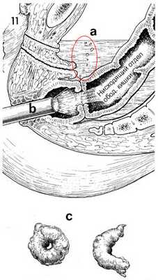 тостокишечно-ректальный анастомоз хирургическим степлером 11