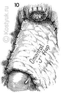 тостокишечно-ректальный анастомоз хирургическим степлером 10