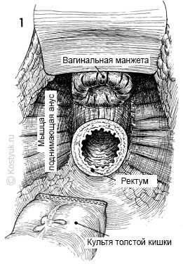 тостокишечно-ректальный анастомоз хирургическим степлером 1