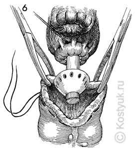 тостокишечно-ректальный анастомоз хирургическим степлером 6