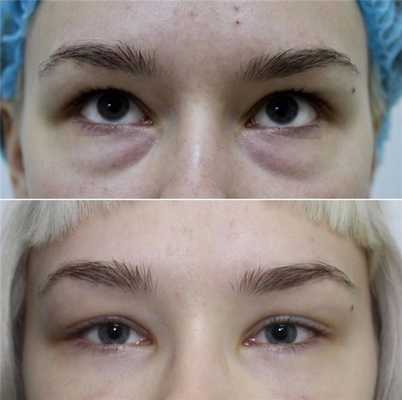 Подготовка к трансконъюктивальной блефаропластике