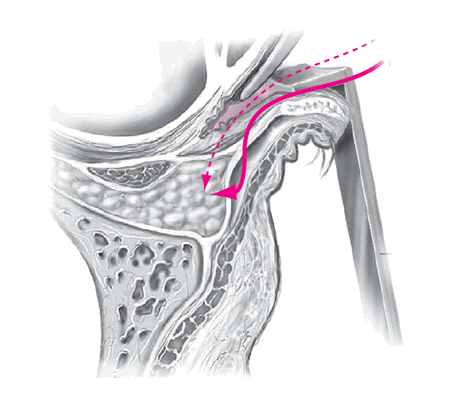 трансконъюнктивальная блефаропластика нижних век, трансконъюнктивальная блефаропластика отзывы, трансконъюнктивальная блефаропластика цена, нижняя трансконъюнктивальная блефаропластика отзывы