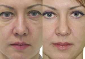 Трансконъюктивальная блефаропластика нижних век