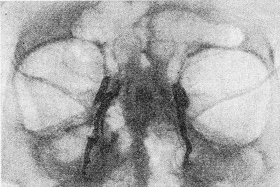 Рис. 2. Дакриоцистограмма. На рисунке слева картина хронического дакриоцистита: слезный мешок и канал расширены, частично закупорено носовое отверстие. Справа без изменений (слезные мешки и слезно-носовые каналы заполнены контрастным веществом).