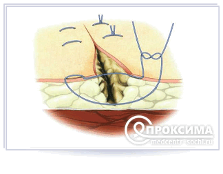 Техника соединения кожи