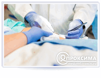 Сшивание кожи и подкожной клетчатки