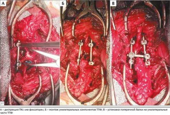 При несоблюдении техники введения стержней-шурупов возможно повреждение нервных структур, распологающихся в позвоночном канале, либо органов, расположенных вблизи позвоночника (легкие, крупные сосуды)
