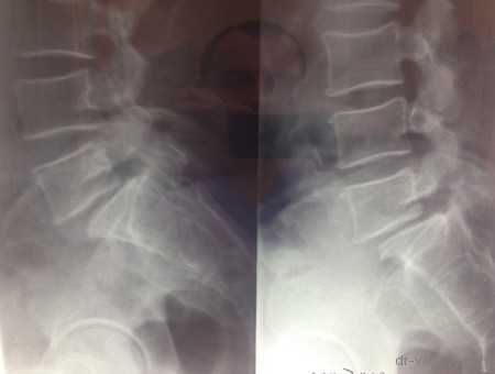 стабилизация системой expedium