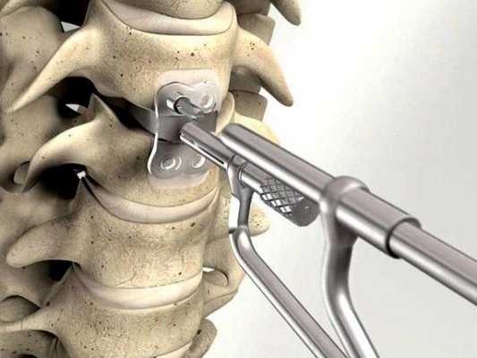 Титановая пластина в позвоночнике