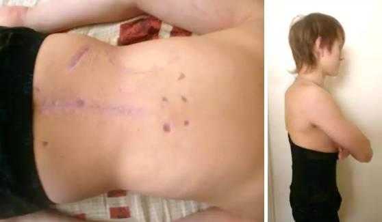 Срок фиксации в аппарате составил 2 месяца. Аппарат демонтирован. Фиксация полужестким пояснично-крестцовым корсетом