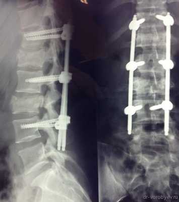 переломы 1-3