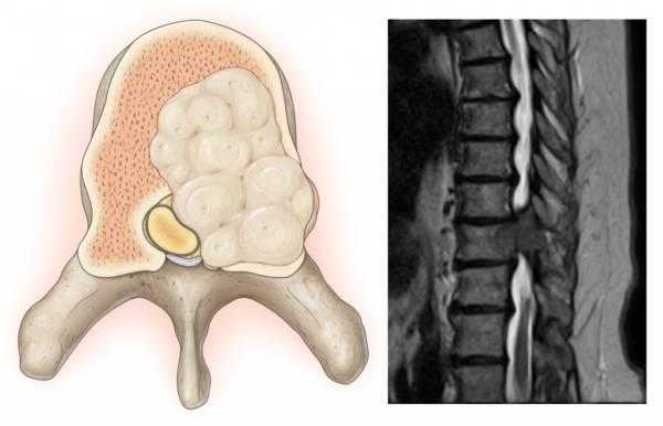 Опухоль позвоночника