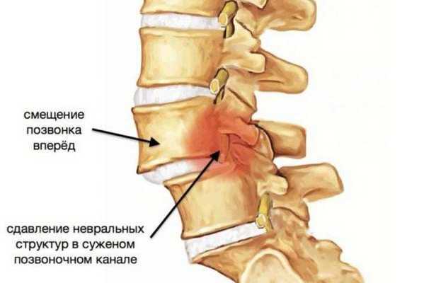 Нестабильность позвонков