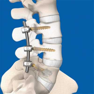 Транспедикулярная фиксация позвоночника