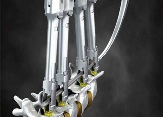 ТПФ - единственная возможность сохранить мобильность пациента, качество его жизни, а нередко и саму жизнь