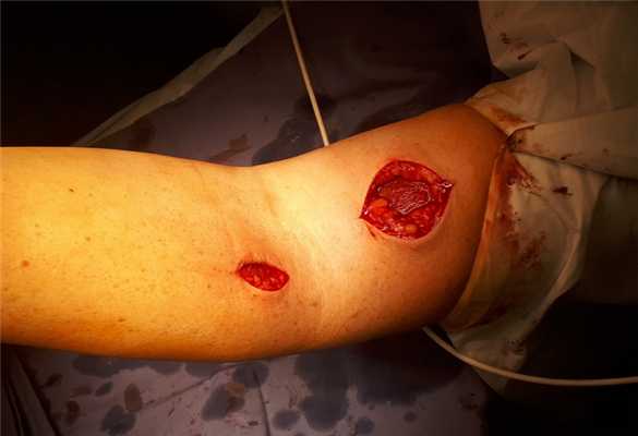 отрывбицепса операционная рана