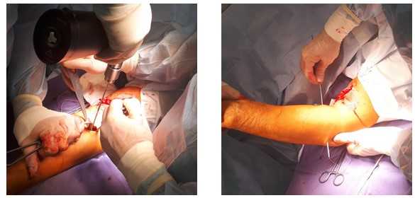 отрыв бицепса операция фиксации сухожилия