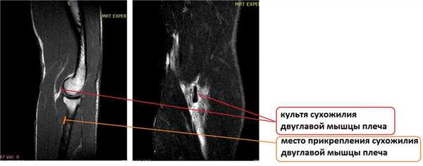 отрыв бицепса мрт