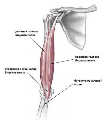 отрыв бицепса