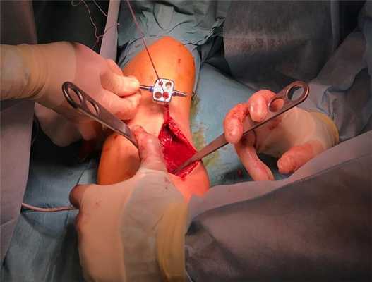 измерение диаметра сухожилия бицепса