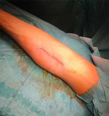 шов бицепса результат операции